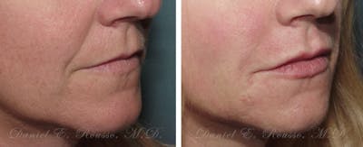 Fillers Before & After Gallery - Patient 1993438 - Image 1