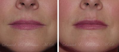 Fillers Before & After Gallery - Patient 1993441 - Image 1