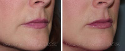 Fillers Before & After Gallery - Patient 1993441 - Image 2