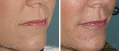 Fillers Before & After Gallery - Patient 1993444 - Image 1