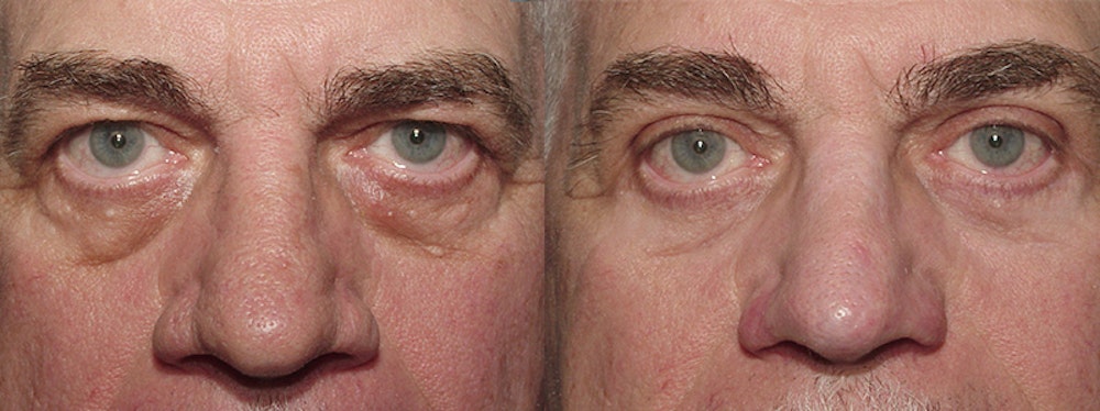 Blepharoplasty Before & After Gallery - Patient 2029504 - Image 1