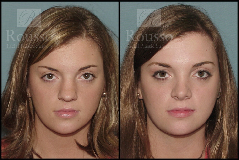 Rhinoplasty Before & After Gallery - Patient 2117630 - Image 3