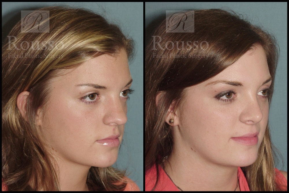 Rhinoplasty Before & After Gallery - Patient 2117630 - Image 2