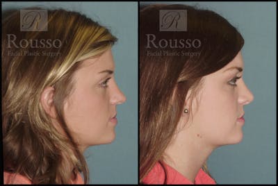 Rhinoplasty Before & After Gallery - Patient 2117630 - Image 1