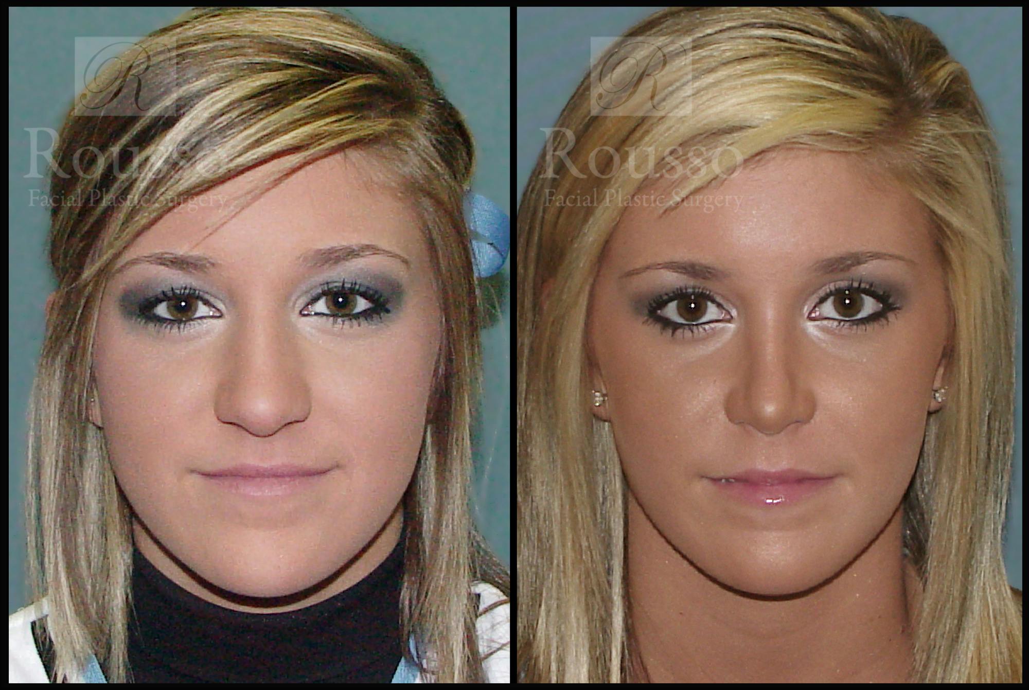 Deviated Septum Covered By Insurance / Fractured Nose Septum Surgery ...