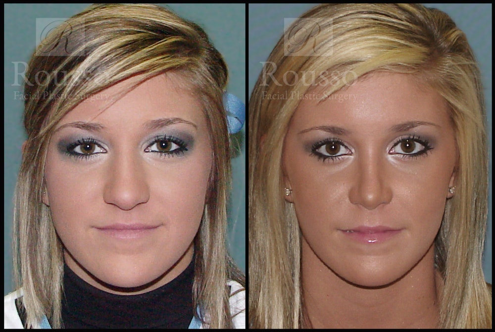 Rhinoplasty Before & After Gallery - Patient 2117638 - Image 2