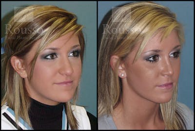 Rhinoplasty Before & After Gallery - Patient 2117638 - Image 1