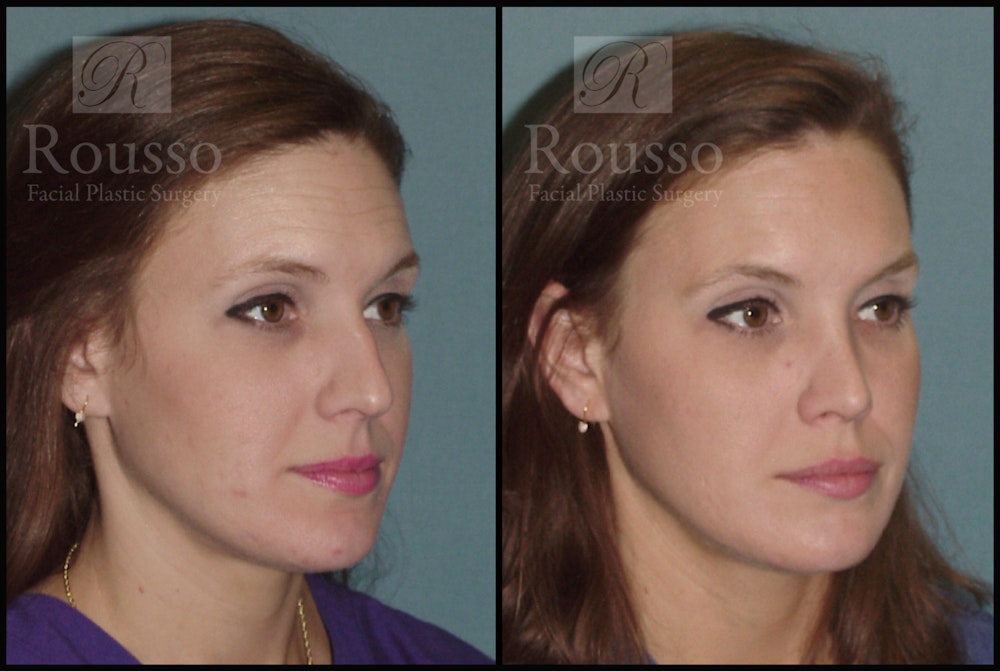 Rhinoplasty Before & After Gallery - Patient 2117639 - Image 2