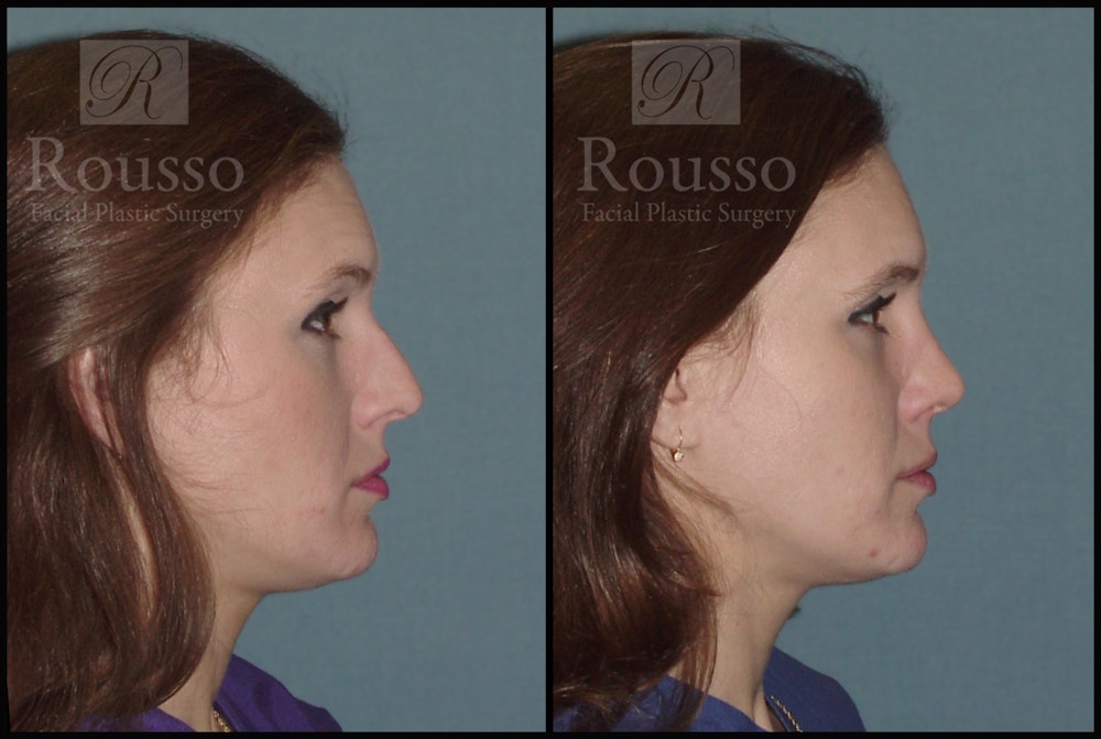 Rhinoplasty Before & After Gallery - Patient 2117639 - Image 1