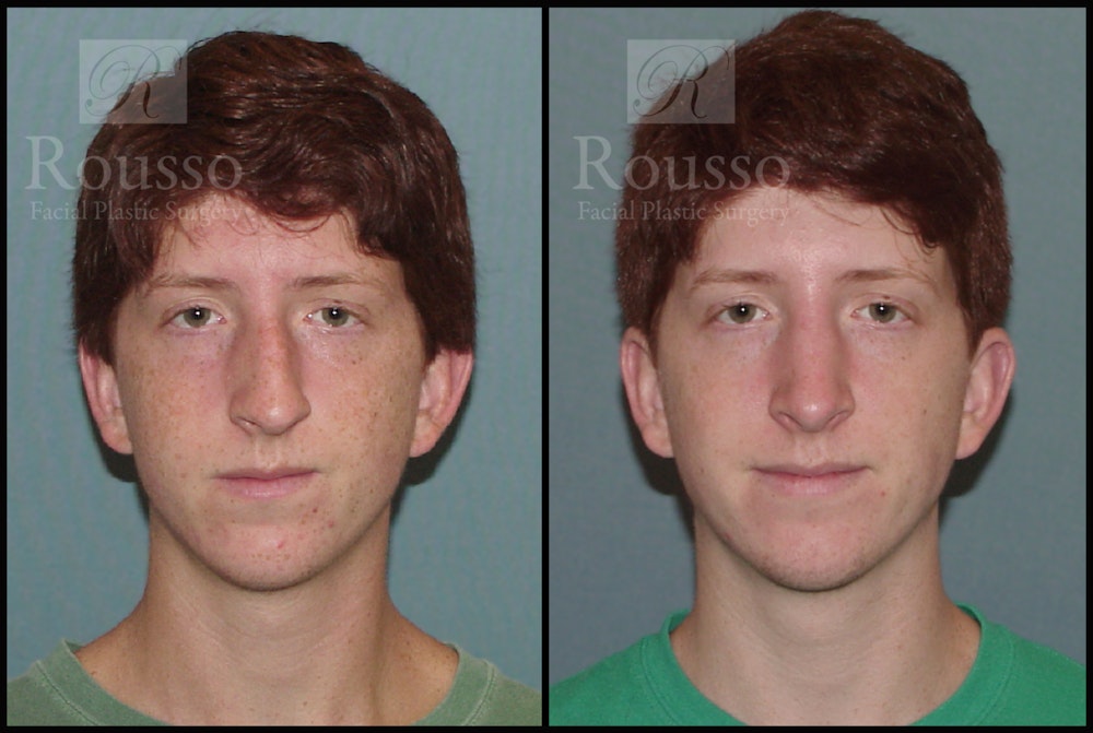 Rhinoplasty Before & After Gallery - Patient 2117641 - Image 3