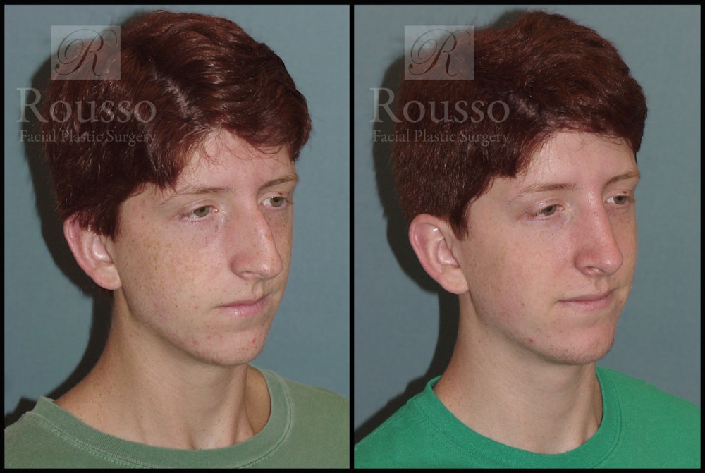 Rhinoplasty Before & After Gallery - Patient 2117641 - Image 1