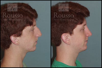 Rhinoplasty Before & After Gallery - Patient 2117641 - Image 1