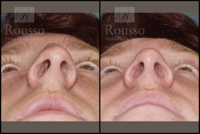 Rhinoplasty Before & After Gallery - Patient 2117641 - Image 4