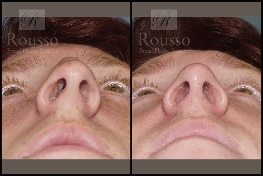 Rhinoplasty Before & After Gallery - Patient 2117641 - Image 4