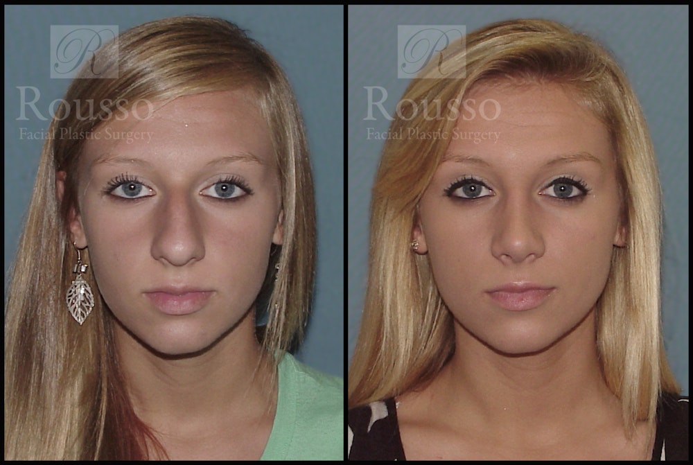Rhinoplasty Before & After Gallery - Patient 2117644 - Image 3