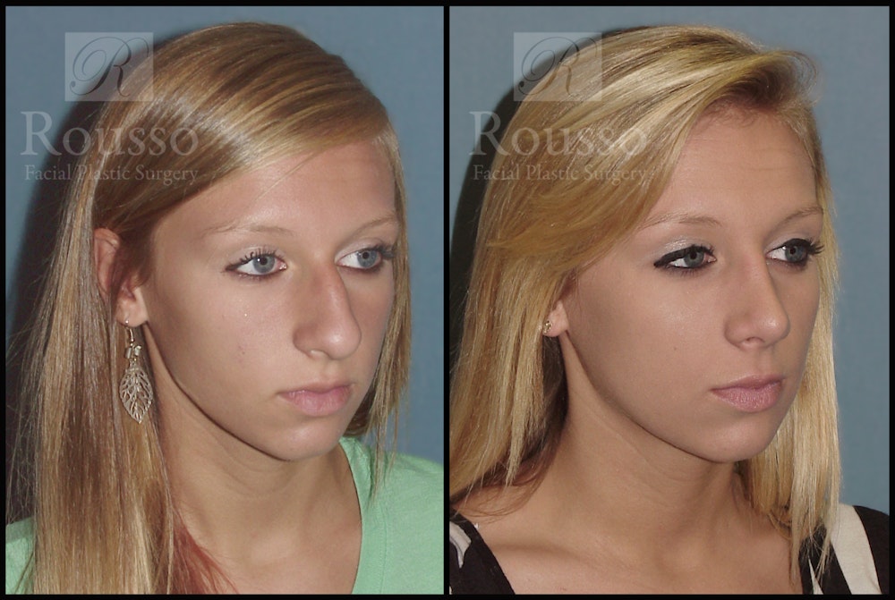 Rhinoplasty Before & After Gallery - Patient 2117644 - Image 2
