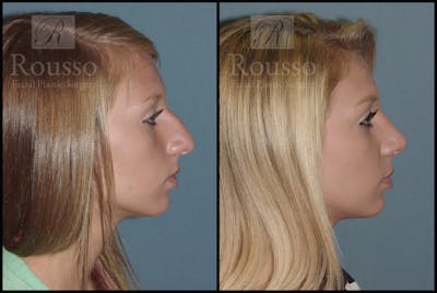 Rhinoplasty Before & After Gallery - Patient 2117644 - Image 1