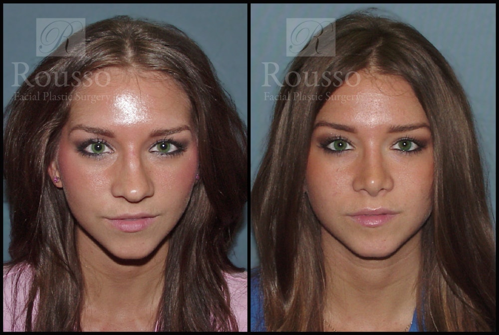 Rhinoplasty Before & After Gallery - Patient 2117645 - Image 2