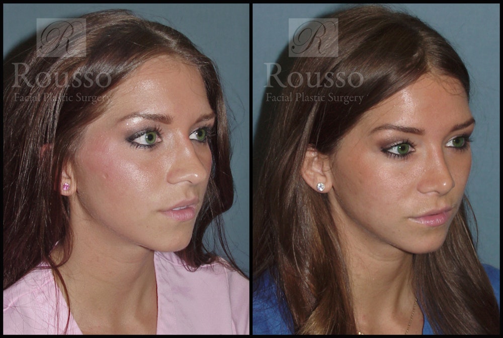Rhinoplasty Before & After Gallery - Patient 2117645 - Image 2