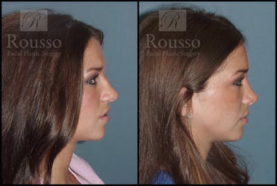 Rhinoplasty Before & After Gallery - Patient 2117645 - Image 1