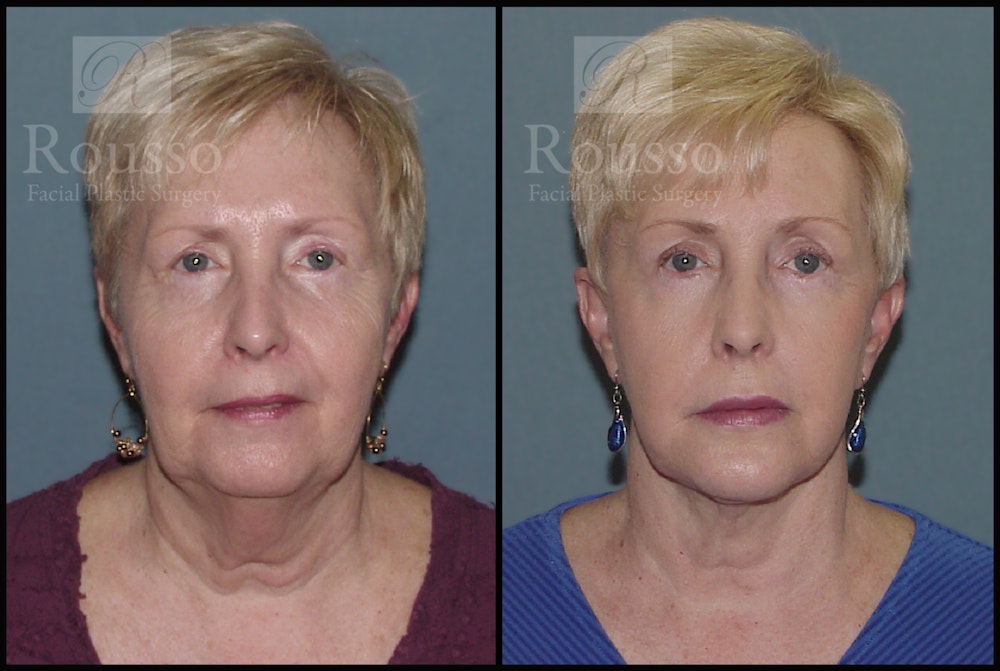 Facelift Before & After Gallery - Patient 2117663 - Image 3