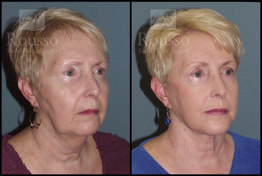 Facelift Before & After Gallery - Patient 2117663 - Image 1