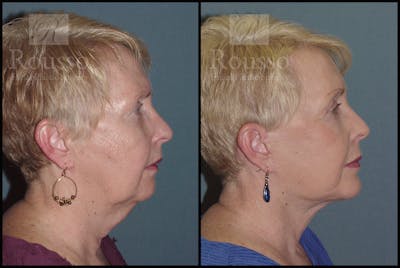 Facelift Before & After Gallery - Patient 2117663 - Image 2