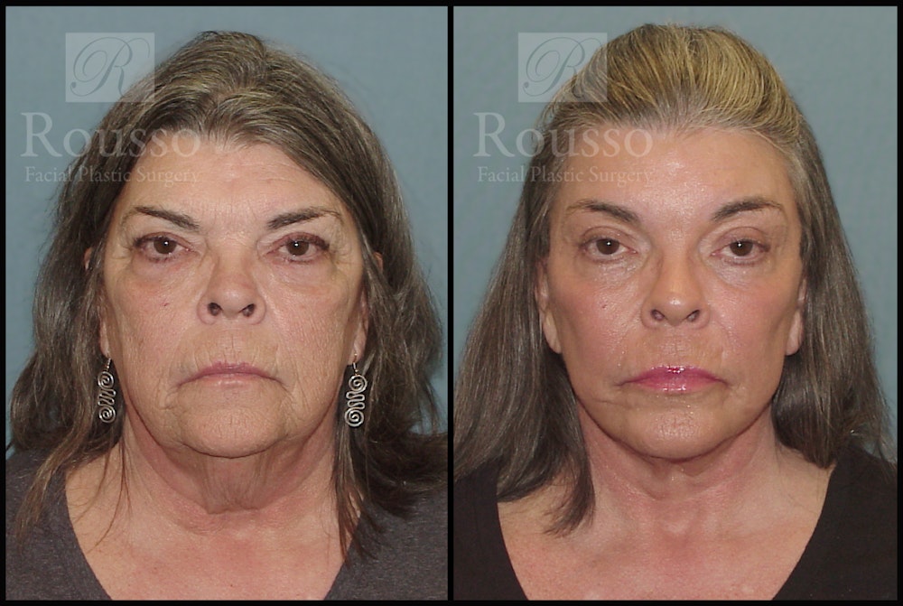 Facelift Before & After Gallery - Patient 2117664 - Image 3