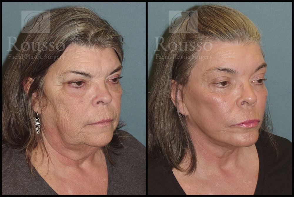 Facelift Before & After Gallery - Patient 2117664 - Image 1