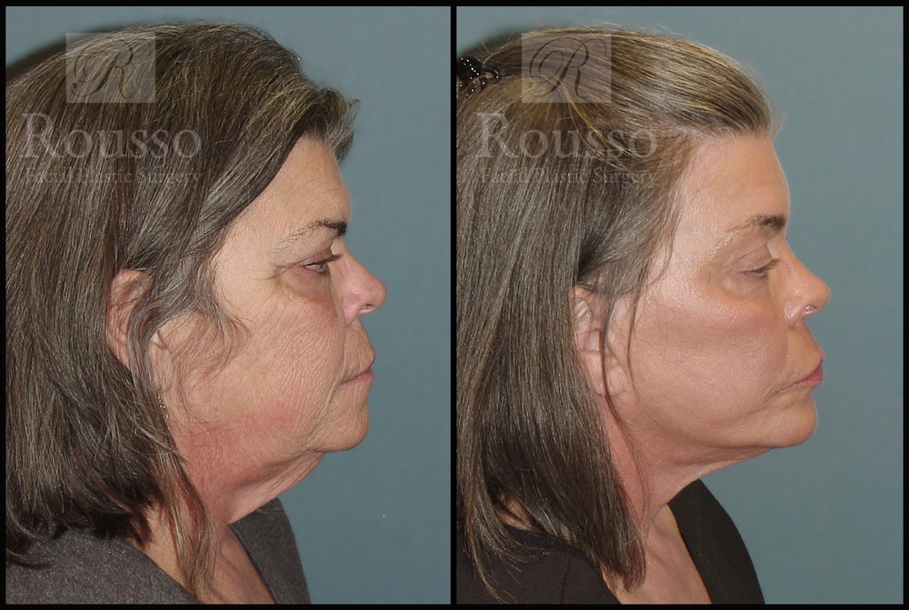 Facelift Before & After Gallery - Patient 2117664 - Image 2