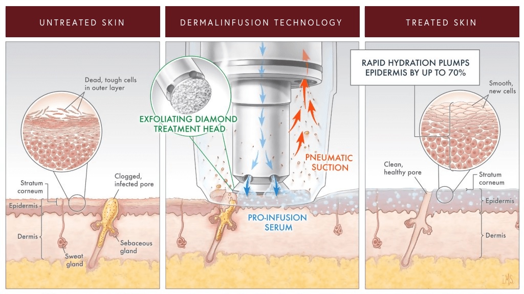 Infographic on How Diamond Glow Dermalinfusion Is Performed