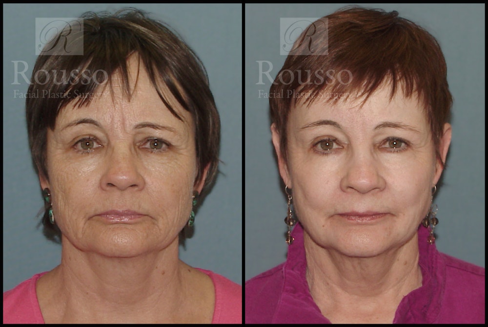 Deep Chemical Peel Before & After Gallery - Patient 147124247 - Image 3