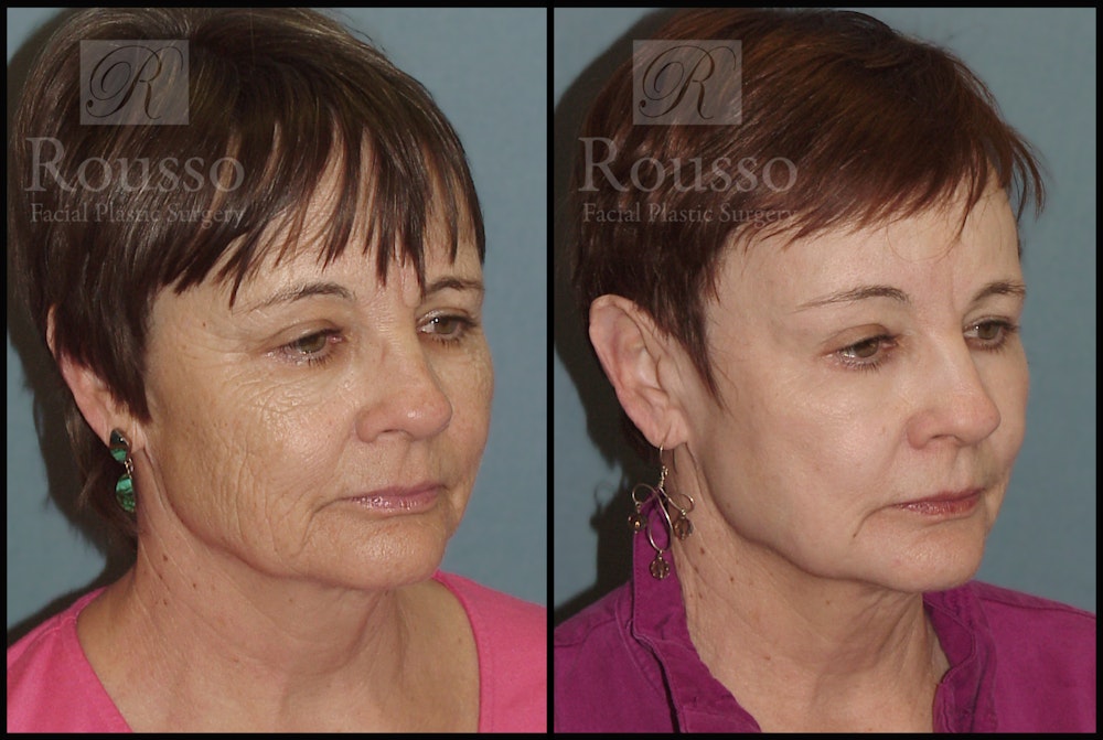 Deep Chemical Peel Before & After Gallery - Patient 2126625 - Image 4