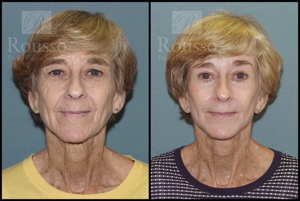 Deep Chemical Peel Before & After Gallery - Patient 147124248 - Image 3