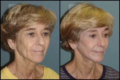 Deep Chemical Peel Before & After Gallery - Patient 2126626 - Image 4