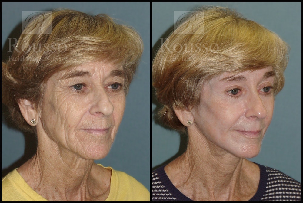 Deep Chemical Peel Before & After Gallery - Patient 147124248 - Image 4