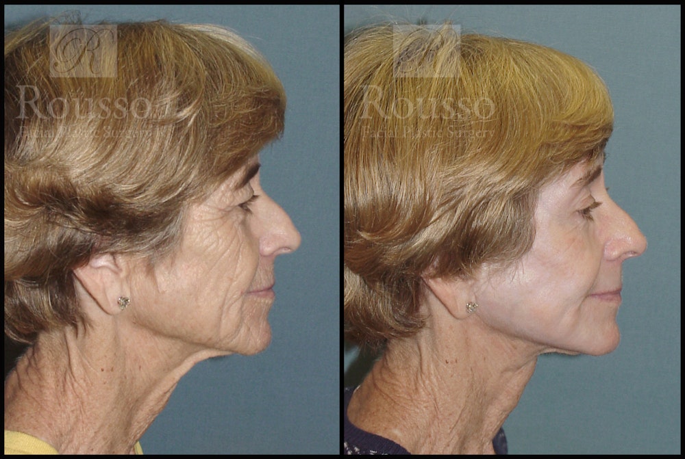 Deep Chemical Peel Before & After Gallery - Patient 2126626 - Image 5