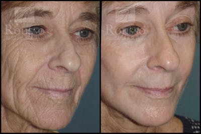 Deep Chemical Peel Before & After Gallery - Patient 2126626 - Image 1