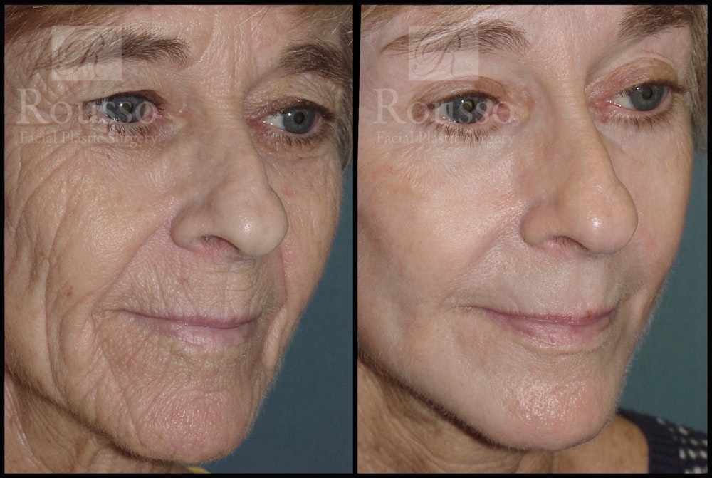 Deep Chemical Peel Before & After Gallery - Patient 147124248 - Image 1