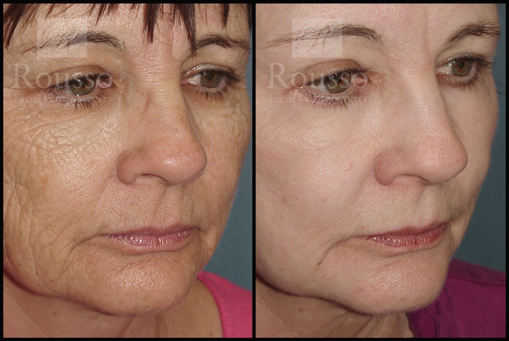 Deep Chemical Peel Before & After Gallery - Patient 2126625 - Image 1