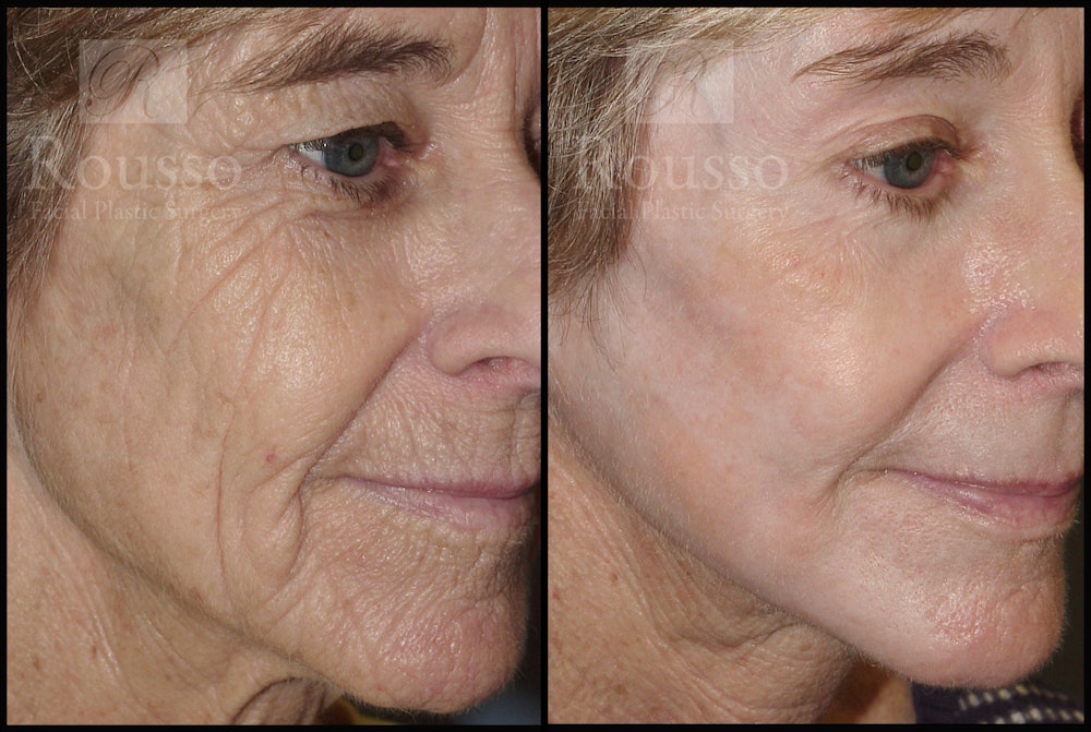 Deep Chemical Peel Before & After Gallery - Patient 2126626 - Image 2