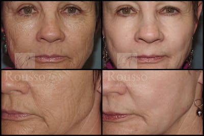 Deep Chemical Peel Before & After Gallery - Patient 2126625 - Image 2