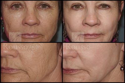 Deep Chemical Peel Gallery <span class=small>By Dr. Daniel Rousso</span> Before & After Gallery - Patient 2126625 - Image 2