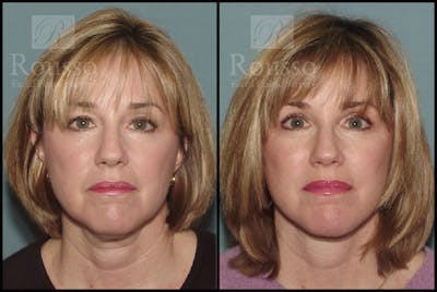 MiniLift Before & After Gallery - Patient 2127511 - Image 1