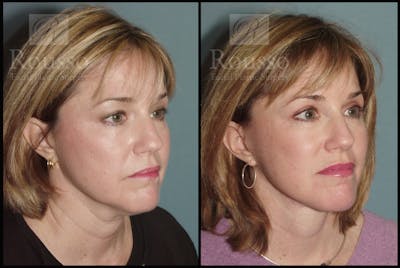 MiniLift Before & After Gallery - Patient 2127511 - Image 2