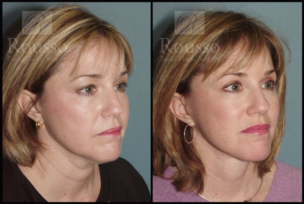 MiniLift Before & After Gallery - Patient 2127511 - Image 2