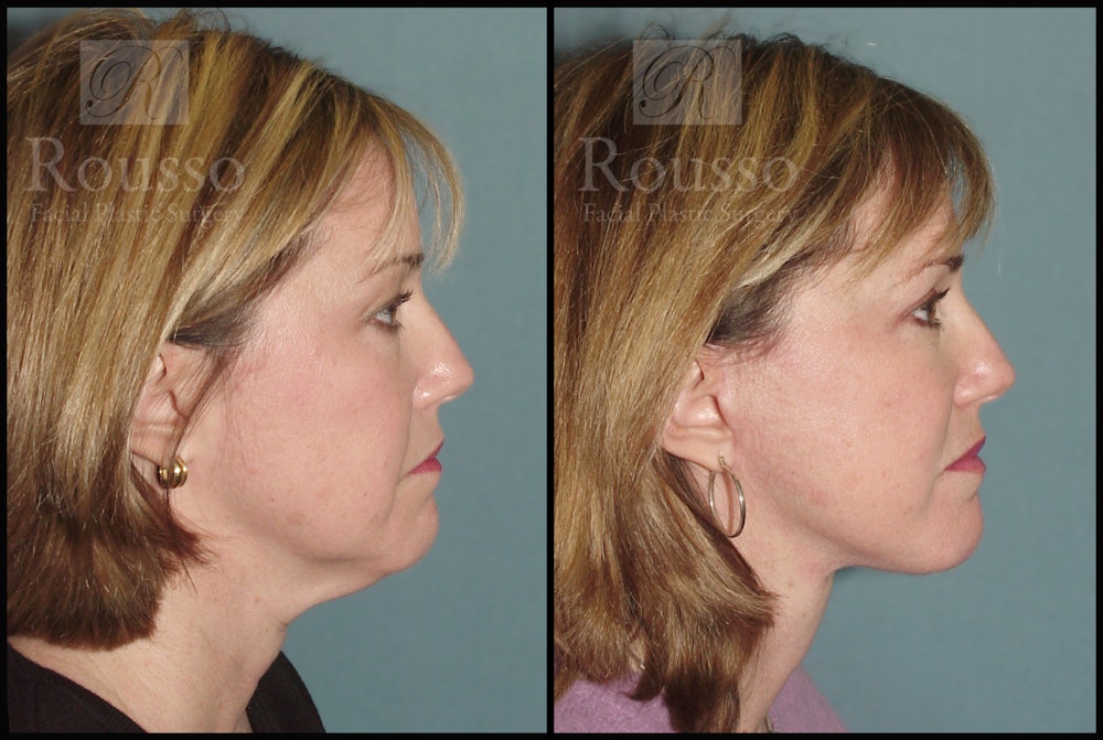 MiniLift Before & After Gallery - Patient 2127511 - Image 3