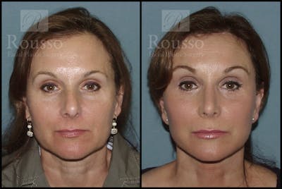 MiniLift Before & After Gallery - Patient 2127513 - Image 1