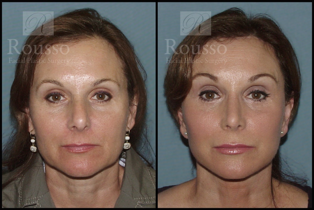 MiniLift Before & After Gallery - Patient 2127513 - Image 1