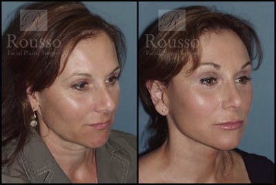 MiniLift Before & After Gallery - Patient 2127513 - Image 2